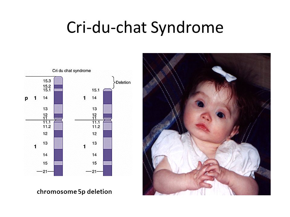 Symptoms and causes of cri du chat syndrome